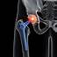 What Are Metal On Hip Replacement Failure Lawsuits  Sibley