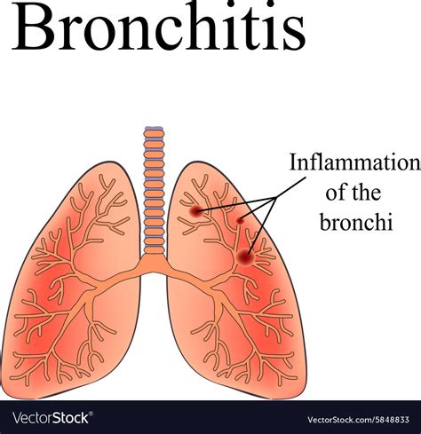 Bronchitis The Anatomical Structure Of The Human Vector Image