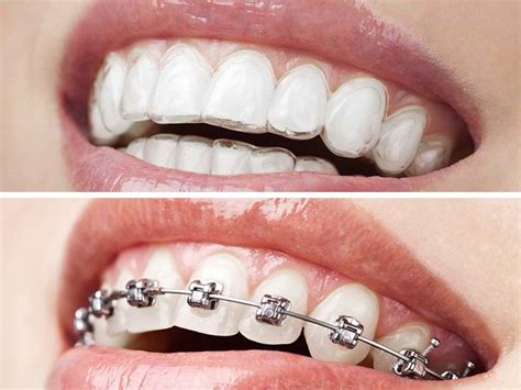 Orthodontics Metal Braces Invisalign Invisalign Metal Braces
