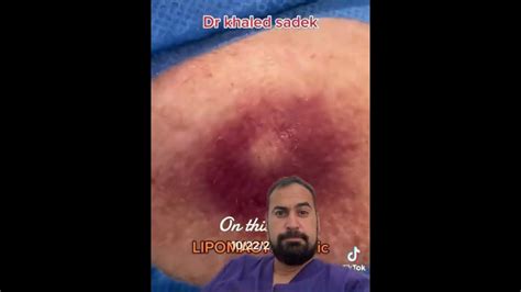 Massive Cyst Infection Blackheadremoval Dr Khaled Sadek Youtube