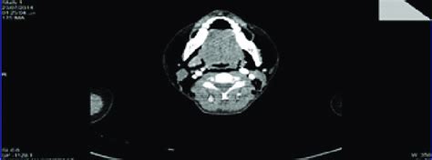 Thoracic Ct Showing Diffuse Soft Tissues Emphysema Of The Neck And