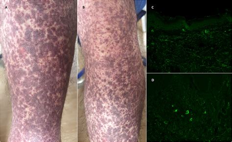 Frontiers Cutaneous Vasculitis Lessons From Covid 19 And Covid 19