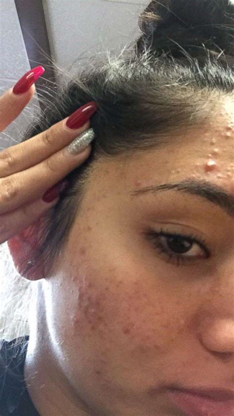 Teen Shares How She Cleared Her Severe Acne Using Cheap Products Abc News