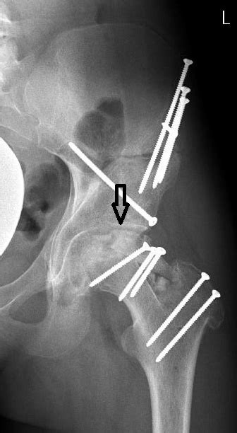 Case One Anteroposterior Radiograph Control Of The Left Hip Three
