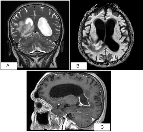 Brain Abscess In A Patient With Chronic Sinusitis Bmj Case Reports