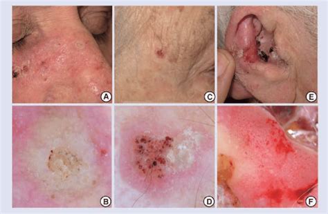 Dermoscopy Of Squamous Cell Carcinoma A Clinical And B Dermoscopic