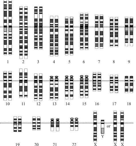 Genetic Origins Of Down Syndrome Wikidoc