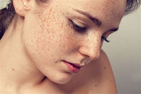 Best Ways To Get Rid Of Freckles