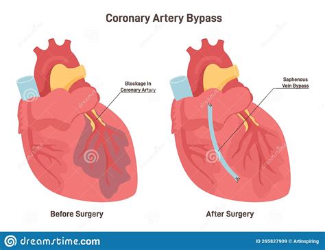 Coronary Artery Bypass Damaged Heart Muscle Blockage Of Coronary