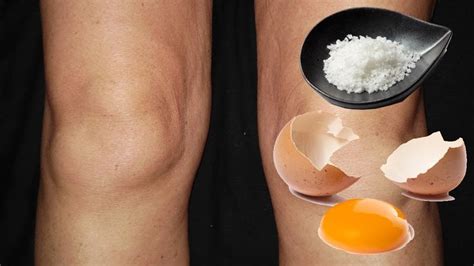 natural 2 ingredient home remedy for treating swollen knees swollen knee home remedies remedies