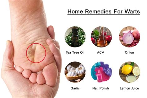 21 Home Remedies To Get Rid Of Warts Naturally
