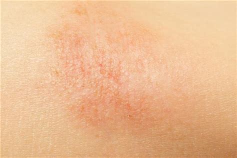 Dry Skin Rashes Pictures Photos