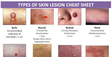 Types Of Skin Lesion Cheat Sheet Ssa Lookbook Cheat Sheets Brain