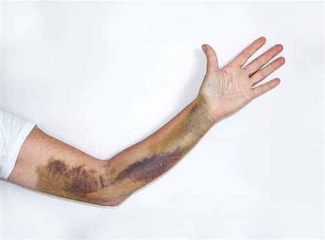 Bruised Arm Stock Photos Pictures And Royalty Free Images Istock