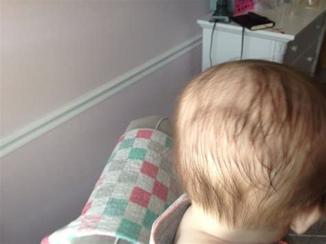 Indent In Back Of Head Pic Page 3 Babycenter