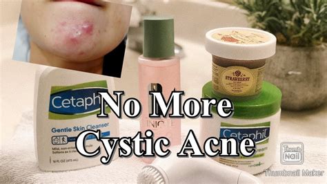 How I Treat And Prevent My Cystic Acne Breakouts Youtube