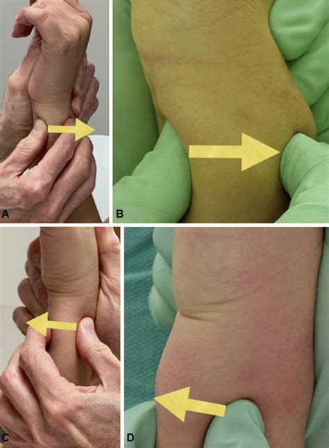 Dorsopalmar Stress Test For Druj Instability Left Wrist Is Shown In Download Scientific