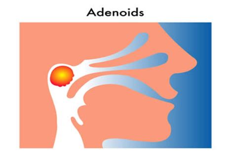 Adenoidectomy Adenoid Removal