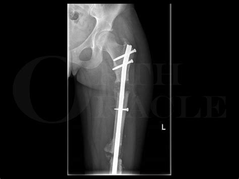Femoral Shaft Fracture Open Femoral Fracture Bone Defect Treated With