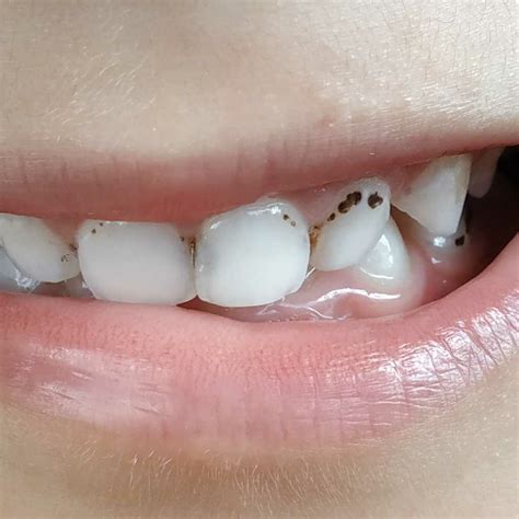 Black Spots On Baby Teeth Captions Update Trendy