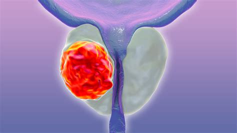 More Benefit With Taxane For Aggressive Metastatic Prostate Cancer MedPage Today
