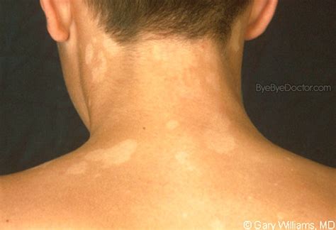 What Is Tinea Versicolor Symptoms Causes Treatment And Prevention Of
