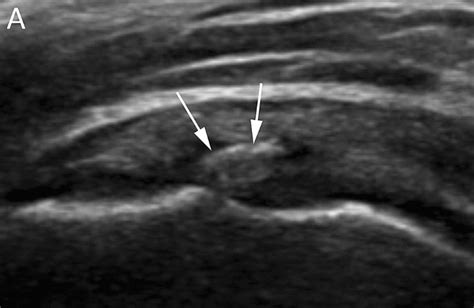 Calcific Tendinitis Of The Shoulder Complete Physio