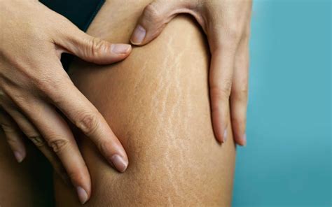 4 Ways To Reduce The Appearance Of Your Stretch Marks Etre Vous