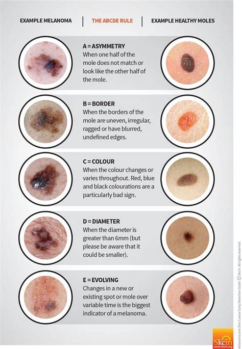 Guide In Detecting Signs Of Skin Cancer Rcoolguides