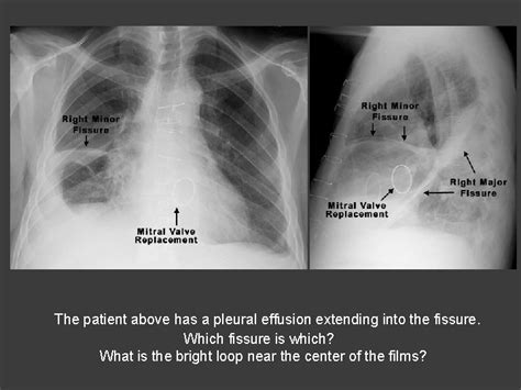 Diagnostic Imaging Normal Chest Anatomy On Xr Technique