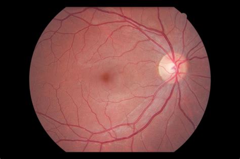 The Patient's Guide to Optic Nerve Drusen - Eyedolatry