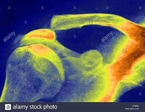 Collarbone X Ray Hi Res Stock Photography And Images Alamy