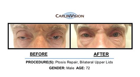 Oculoplastics Before And Afters Carlinvision