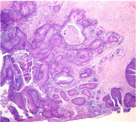 Pathology Of Cancers Of The Female Genital Tract Prat 2015 International Journal Of
