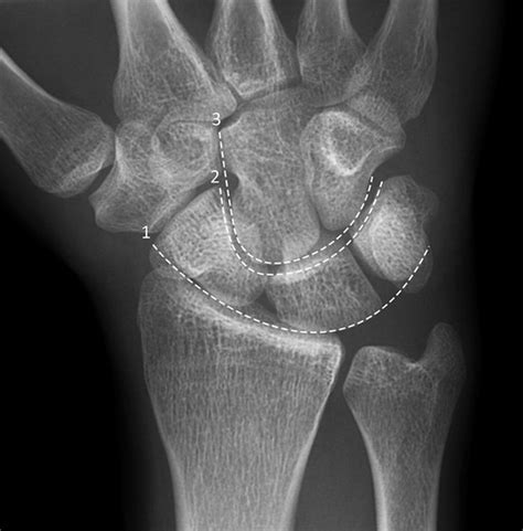 Interpreting The Wrist Radiograph In Adult Trauma The Bmj