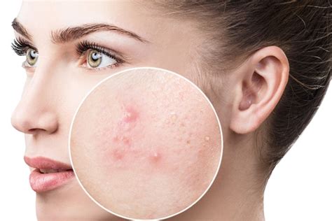 What Causes Black Spots On The Face And How To Get Rid Of Them Be