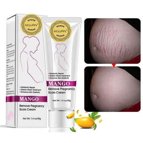 Rtopr Mango Stretch Marks And Scar Cream Stretch Marks And Scar Removal Cream For Pregnancy