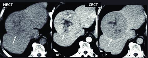 CT Evaluation Liver Adenoma With Central Necrotic Area And