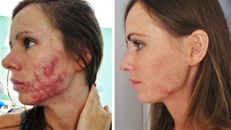 Acne Pop Up What Is Accutane Zel Skin And Laser Specialists