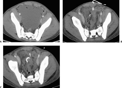 50 Abscess Drainage Radiology Key