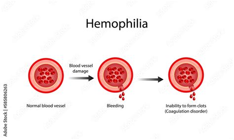 Hemophilia A Bleeding Disorder That Slows The Blood Clotting