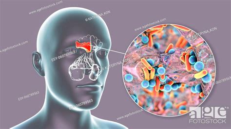 Sinusitis Inflammation Of Paranasal Cavities 3d Illustration Showing