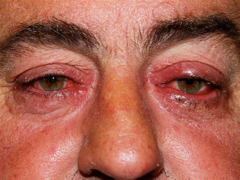 Rosacea Seeing Red In Primary Care Bpj 75 May 2016