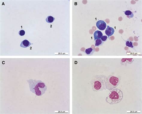 Cerebrospinal Fluid Cytology A Highly Diagnostic Method For The