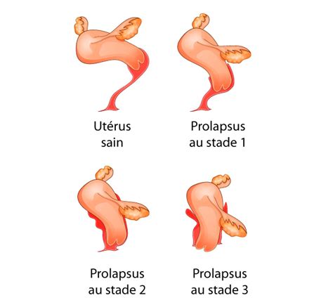Chirurgie Des Prolapsus Lyon Cub Centre D Urologie Bellecour Charcot
