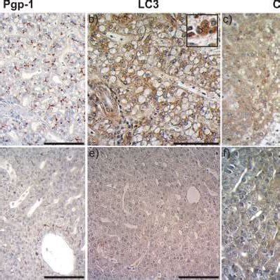 Immunohistochemical Staining Of Pg P Lc Ii And Cathepsin D In The Download Scientific