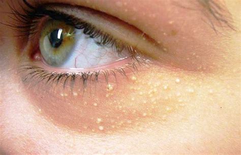 How To Remove Cholesterol Deposits Around The Eyes Bumps Under Eyes