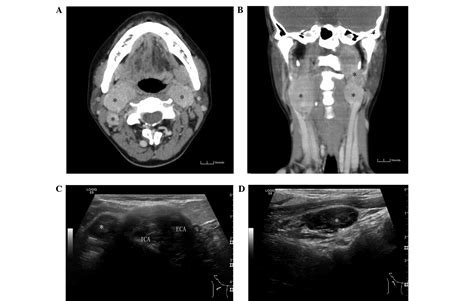 Imaging Findings Of Malignant Bilateral Carotid Body Tumors A Case
