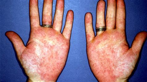 Rheumatoid Arthritis Rash Causes Treatment And Images