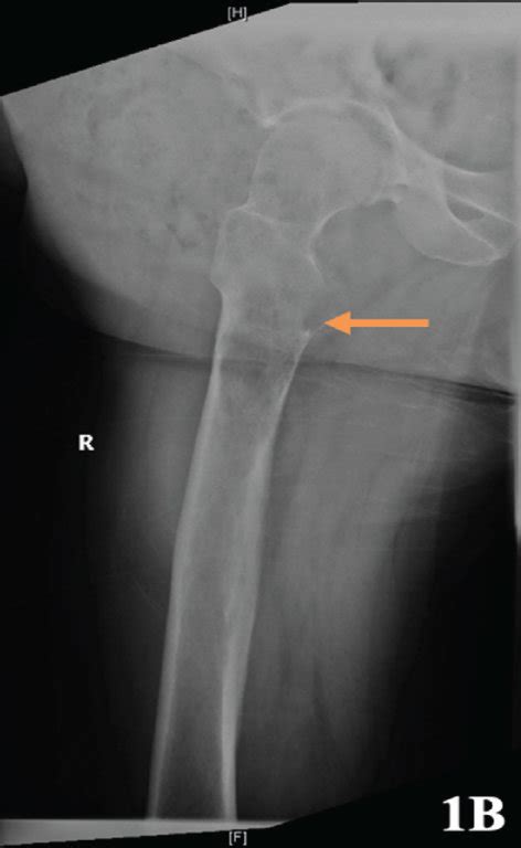 Initial Anteroposterior And Lateral Radiographs Of The Right Femur A